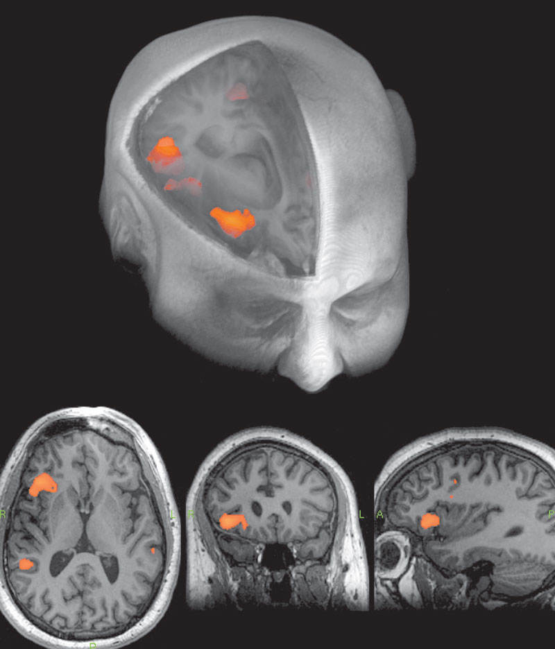 Brain Imaging Alzheimer’s and Parkinson’s Detection Lakeland, FL RIS